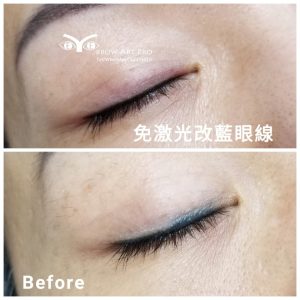 洗眼線-非激光洗眼線暈色變藍案例